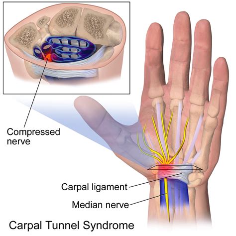 Biaya Operasi Carpal Tunnel Syndrome 6