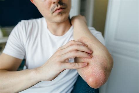 Eczema Facts and Statistics: What You Need to Know