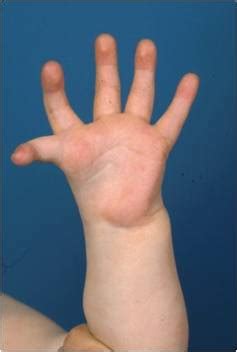 The hypoplastic thumb. - Post - Orthobullets