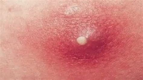 Carbuncles: Causes and Risk Factors
