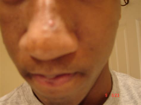 First Class Tips About How To Get Rid Of Bumps On My Nose - Effectsky