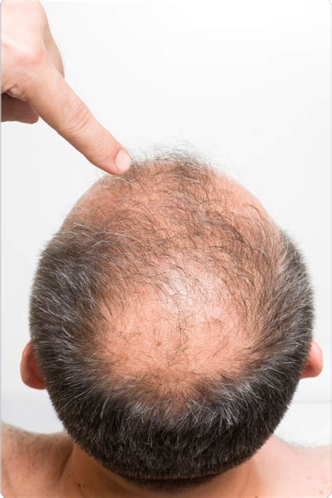 Does Masturbation Cause Hair Loss? - NowPatient