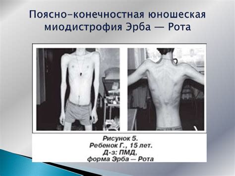 Прогрессирующие мышечные дистрофии - презентация онлайн