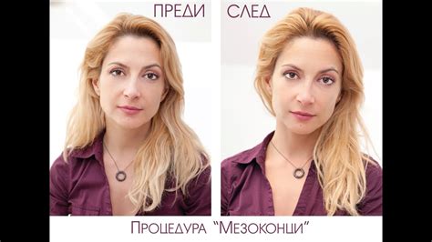 Поставяне на 3D мезоконци. Пациент: Топ-журналистката Ива Дойчинова ...