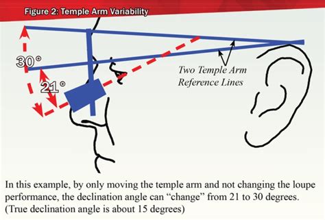 Demystifying Declination Angle - SurgiTel Ergonomic Loupes