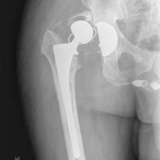 schematic   tripolar constrained liner construct reviewed
