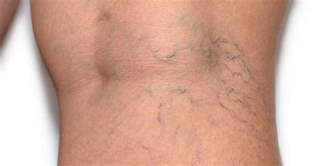 What Causes Spider Veins? | Lexington Vein Institute