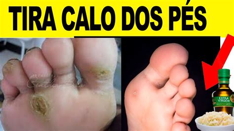 Como Tirar O Calo Do Pé - Como Acabar Com os Calos nos Pes DE UMA VEZ POR TODAS, DORES NOS PES ...