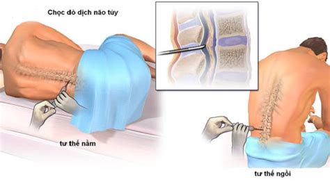 Những điều nên biết về chọc dò tủy sống
