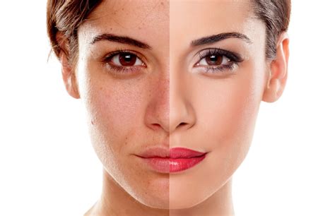 Models with Bad Skin are More Common than You Think - UK Models