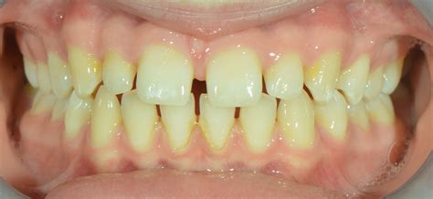 Aesthetic Update - To bond or not to bond: considerations for choosing