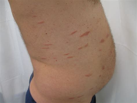 Plaque Skin Lesion