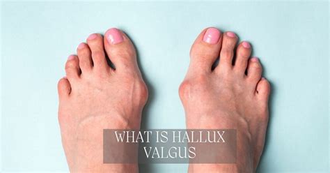 What is Hallux Valgus? - Foot & Ankle Center of Arizona