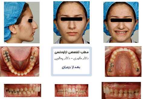تصاویر قبل و بعد از درمان - کلینیک تخصصی ارتودنسی دکتر یعقوبی و دکتر مظهری