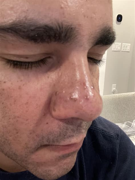 Bumps on nose for 10 years. What are they? They are not pimples because