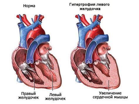 Увеличение левого желудочка сердца: признаки, диагностика, лечение ...