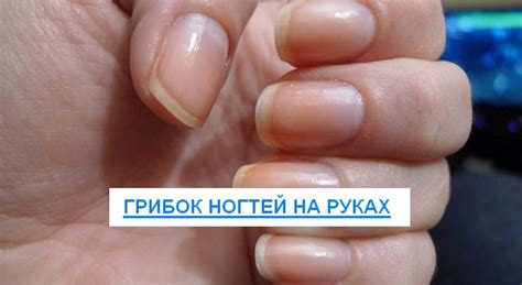 Грибок ногтей на руках: причины, группы риска, виды, стадии, лечение
