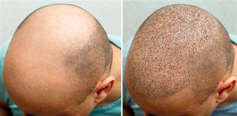 Stages of Growth After a Transplant - The Hair Loss Recovery Program