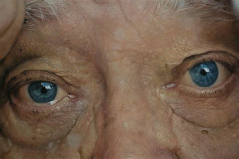 Enhancing Vision in Seniors Through Cataract Surgery — Exploratory
