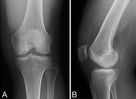 Platelet-rich plasma induced healing of a chronic osteochondral defect