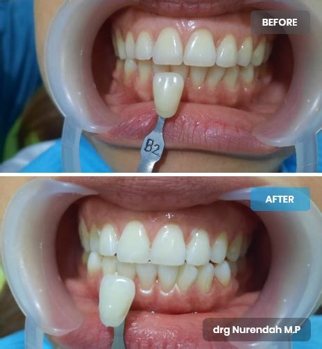 bleaching griya denta