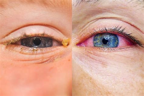 viral  bacterial pink eye