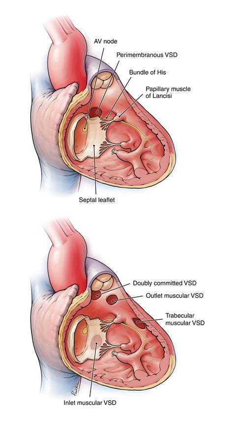 Ventricular Septal Defects (VSD) | Adult and Pediatric Cardiac