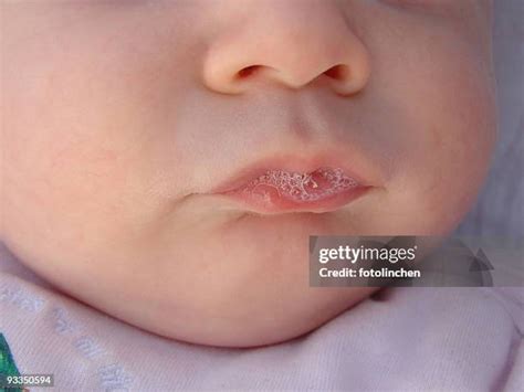 Mouth Blisters Photos and Premium High Res Pictures - Getty Images