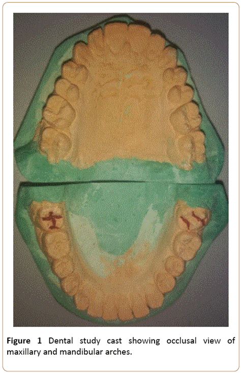 Carabelli Cusp Mandibular