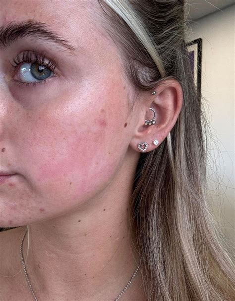 “Horrific”: Woman Suffers Second-Degree Burns After Getting Popular ...