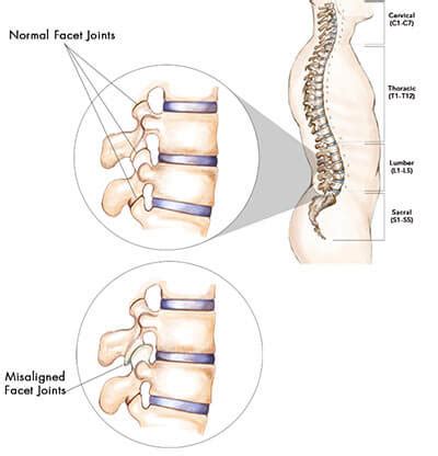 Facet Joint Syndrome Treatment Doctors (Back Pain Specialists) Brooklyn ...