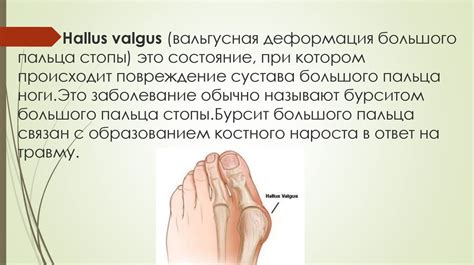 Вальгусная деформация стопы - презентация онлайн