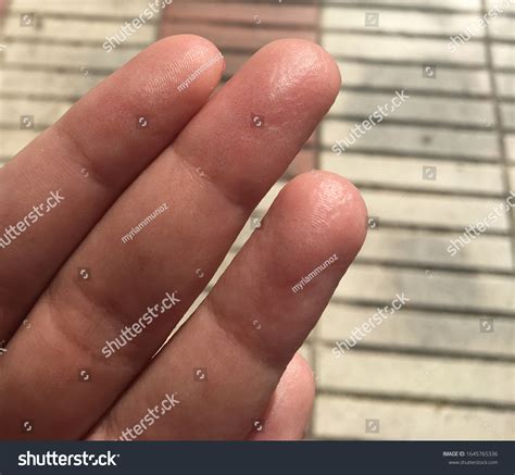 Dyshidrotic Eczema Known Pompholyx Cheiropompholyx Fingers Stock Photo ...