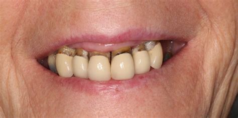 types  dentures  comprehensive guide  vallance dental centre