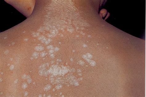 Lichen Sclerosus Et Atrophicus Back