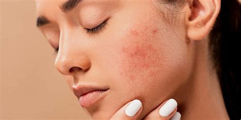 Rosacea Signs, Symptoms, and Treatments! - Bellaire Dermatology