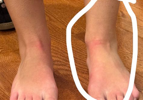 What could this be? Random indent on ankle : r/Orthopedics