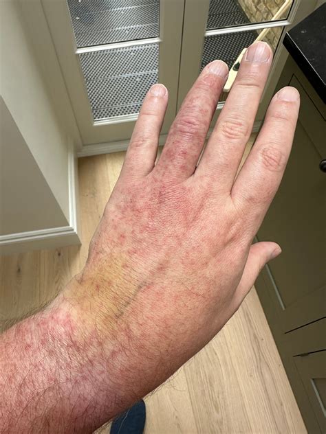 House Centipede Bite Symptoms Does A Garden Centipede Bite Garden