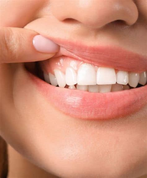 Gum Graft Surgery in Odessa, FL | Spring Haven Dental