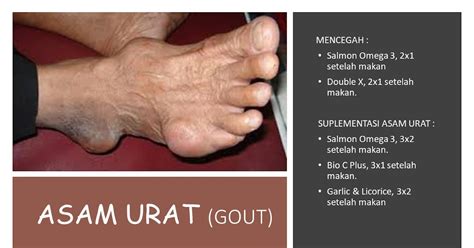 asam urat gout