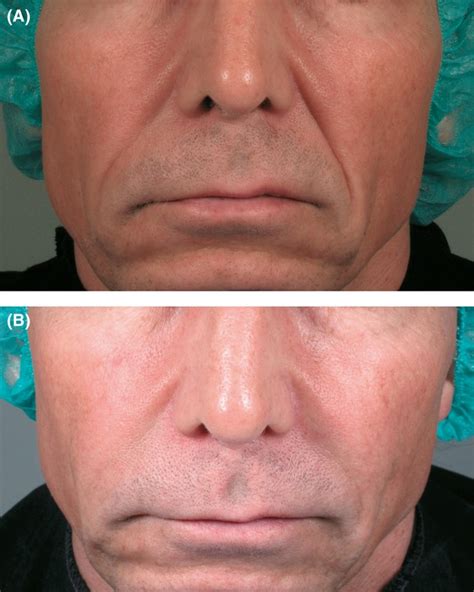 A 49-year-old man who received 1.5 mL of PCL-1 in the left and 1.0 mL ...