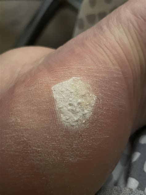 Plantar wart journey : r/Warts