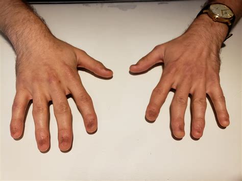 Guy I work with has no fingernails : r/WTF