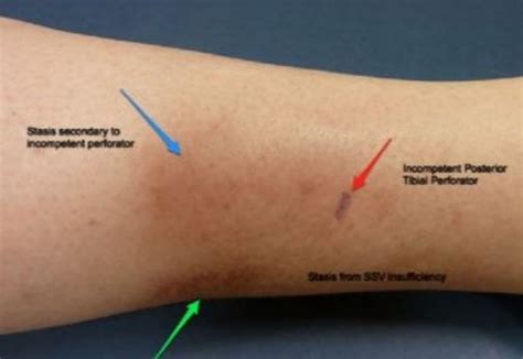 Blood Clot in Leg - Symptoms, Signs, Causes, Diagnosis, Treatment