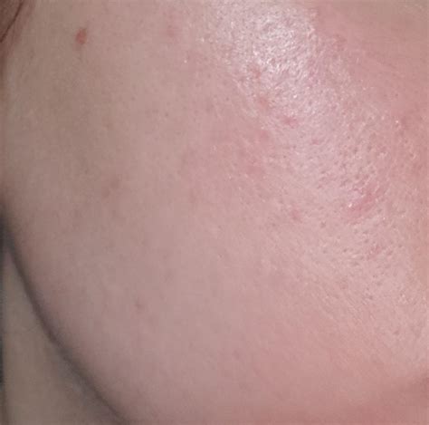 [Acne] Popped Cystic Acne : r/SkincareAddiction