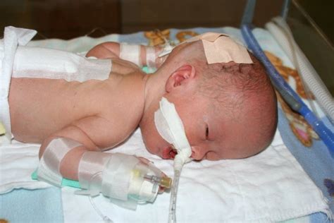 shunt surgery update sarah joy albrecht