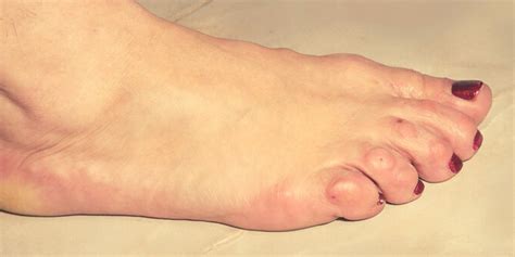 Foot Corns - Remedies, Removal, Relief UgleeFeet.com!