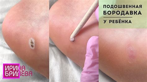 Детская бородавка на стопе 🌸 Убираем бородавку за несколько сеансов 🌸 ...