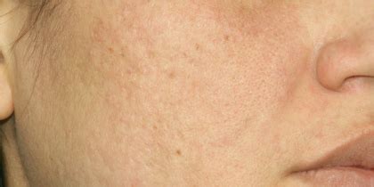 patient  active max fx laser     phoenix