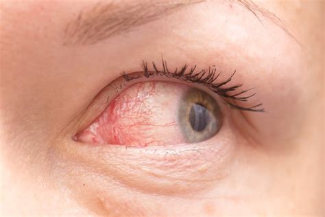 COVID-19 symptoms: The latest variant is causing pink eye, doctors say ...
